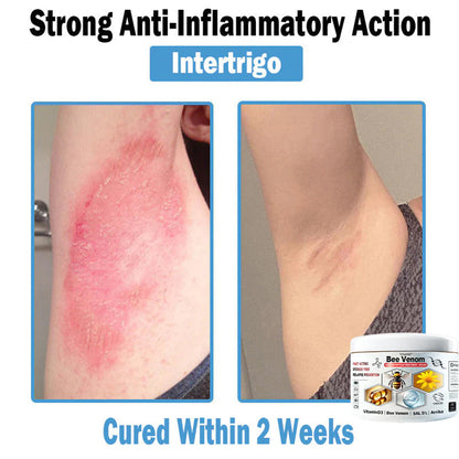 Trilumia® Bee Venom Multi-Symptom Skin Treatment Cream(👨‍⚕ Recommended by the British Association of Dermatologists – BAD) ⏰50% Off for a Limited Time – Sponsored by Boots