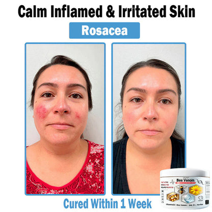 Trilumia® Bee Venom Multi-Symptom Skin Treatment Cream(👨‍⚕ Recommended by the British Association of Dermatologists – BAD) ⏰50% Off for a Limited Time – Sponsored by Boots